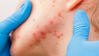 iStock-660804440.jpg Acne skin